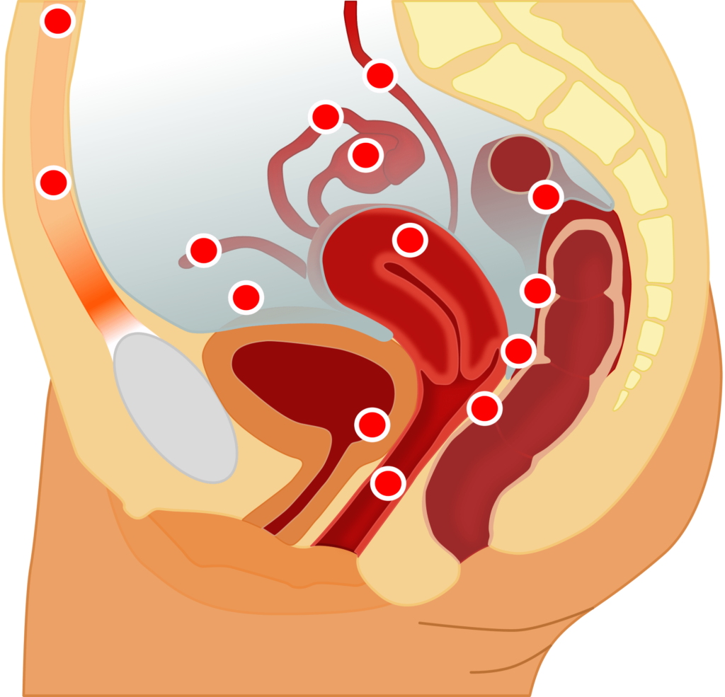 ¿Qué es la endometriosis?