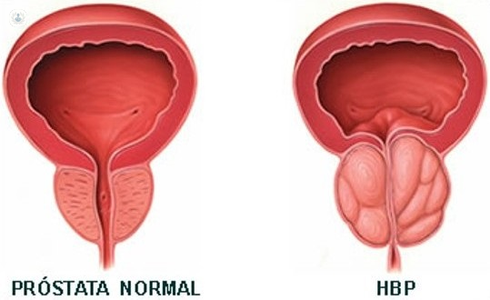 ¿Qué es la hipertrofia prostática benigna?