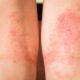 ¿Qué es la dermatitis atópica?