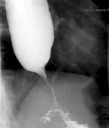 ¿Qué es la Acalasia?