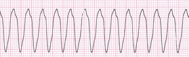 ¿Qué es la taquicardia ventricular?