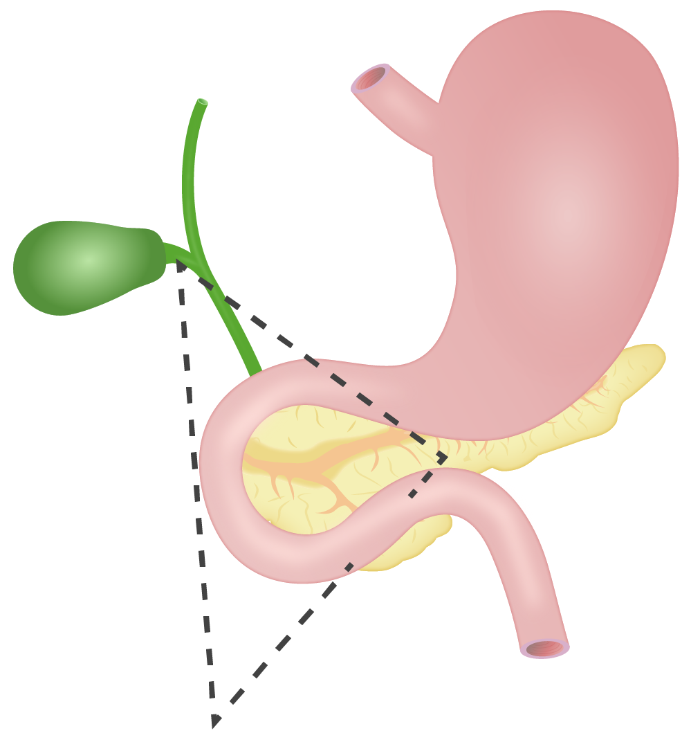 ¿Qué es un gastrinoma?