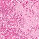 ¿Qué es la amiloidosis?