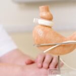 ¿Cómo saber qué pacientes que son candidatos a cirugía bariátrica?