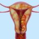 ¿Qué es el adenocarcinoma de endometrio?