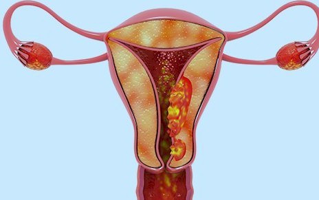 ¿Qué es el adenocarcinoma de endometrio?