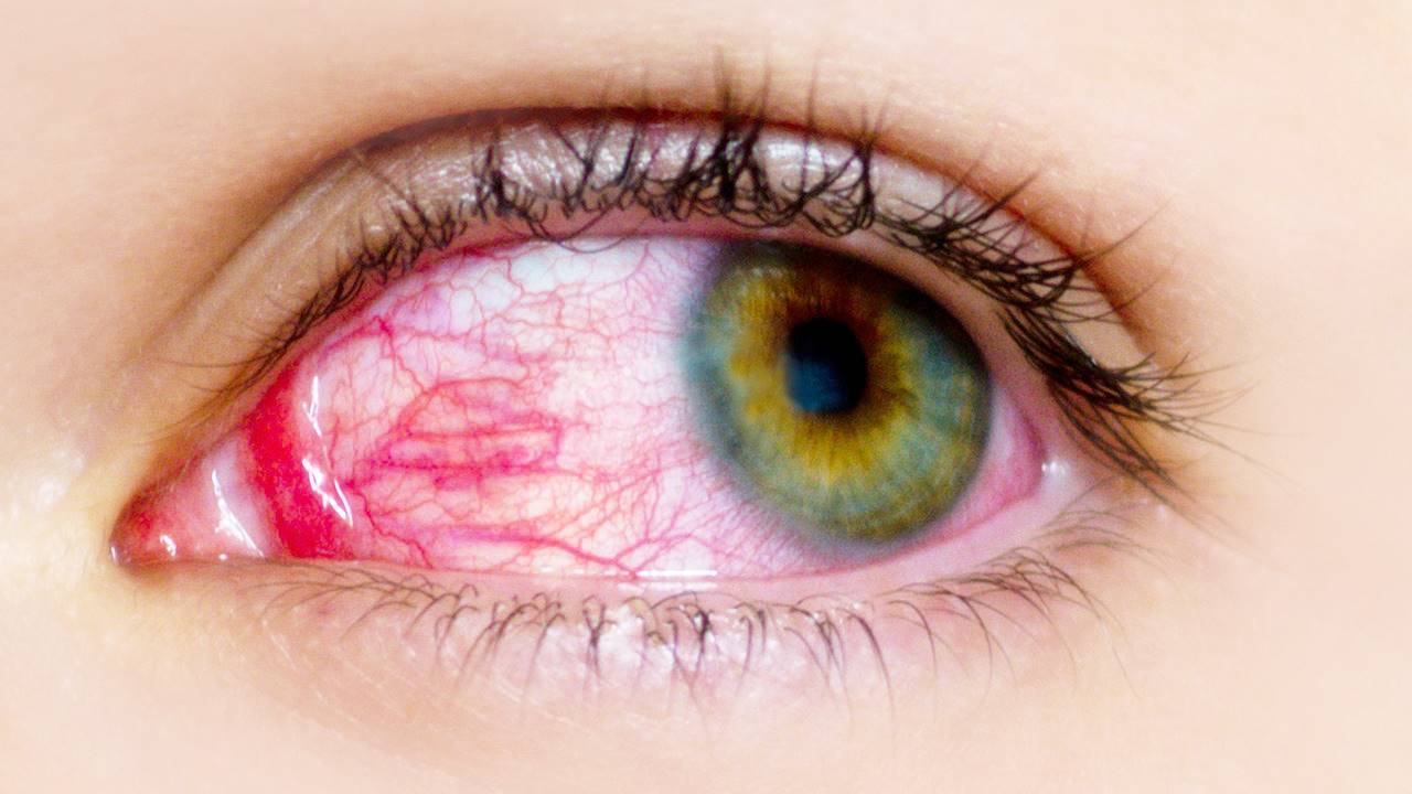 Conjuntivitis alérgica estacional y perenne Conjuntivitis alérgica estacional y perenne