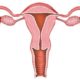 ¿Cuáles son las causas de sangrado uterino anormal?