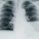 ¿Cuáles son los datos para el diagnóstico de derrame pleural?