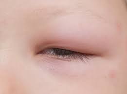 Celulitis preseptal causada por Haemophilus influenza en niños.