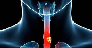 ¿Qué es el cáncer de esófago?