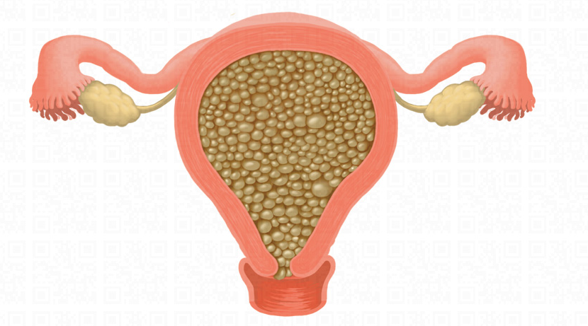 Enfermedad trofoblástica gestacional