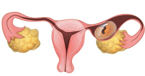 ¿Qué es un embarazo tubárico?