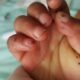 ¿Cuáles son las manifestaciones cutáneas de endocarditis infecciosa?