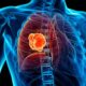 ¿Qué es el cáncer de pulmón?