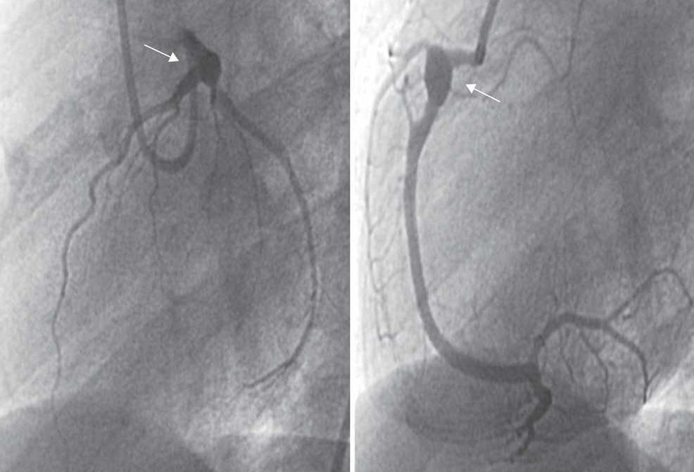 Enfermedad de Kawasaki