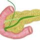 ¿Qué son las neoplasias mucinosas papilares intraductales del páncreas?