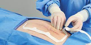 ¿Cómo prevenir las infecciones de heridas quirúrgicas?