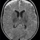 ¿Qué es el empiema subdural?