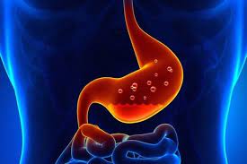 ¿Qué es la enfermedad ulcerosa péptica?