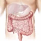 ¿Qué es el síndrome de colon irritable?