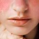 Lupus Eritematoso Sistémico