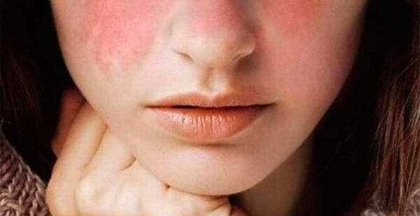 Lupus Eritematoso Sistémico