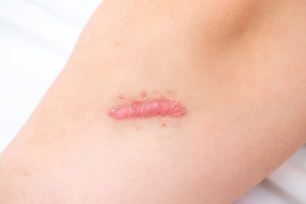 ¿Qué son las cicatrices hipertróficas y queloides?