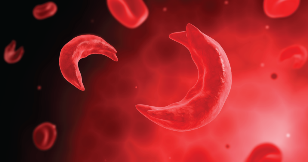 ¿Cuáles son las alteraciones de la hemoglobina en la anemia falciforme?