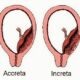 ¿Qué es la placenta accreta?