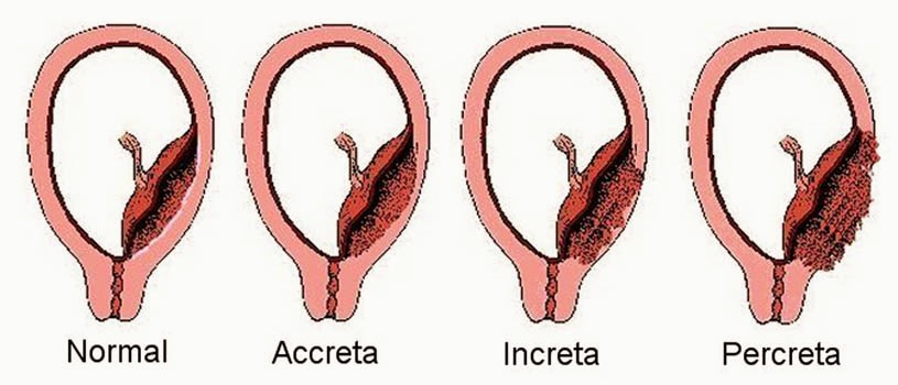 ¿Qué es la placenta accreta?
