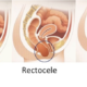 ¿Cuáles son las hernias vaginales?