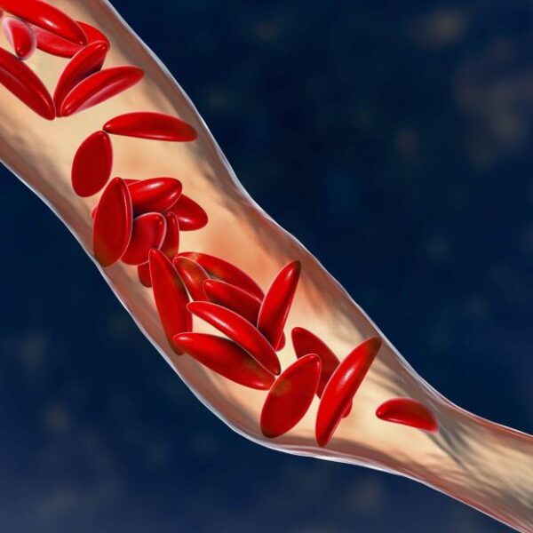 Anemia Drepanocítica