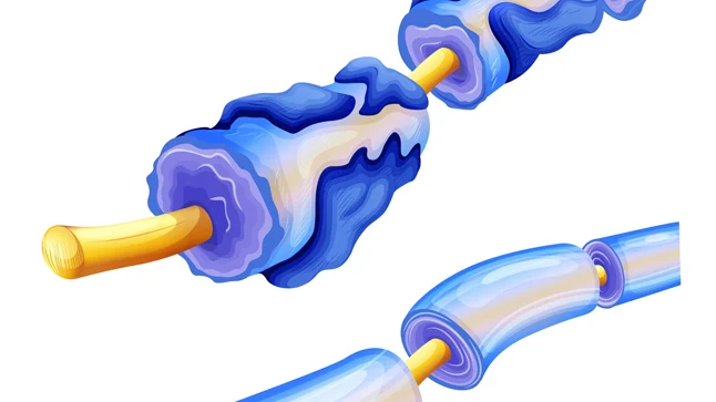 ¿Qué es el síndrome de Guillain–Barré?