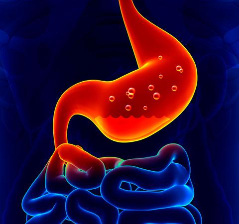 ¿Qué es la gastritis por Helicobacter pylori?