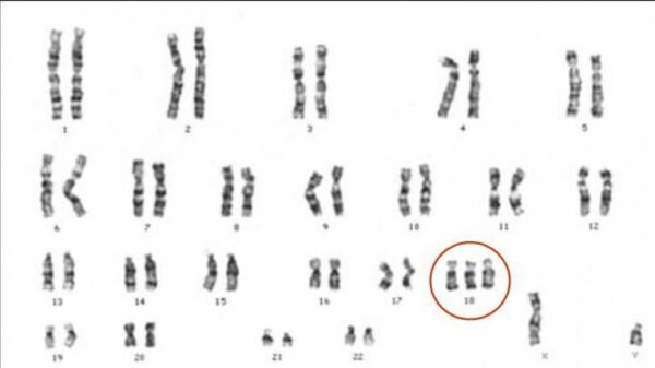 ¿Qué es el síndrome de la trisomía 18 o síndrome de Edwards?