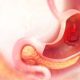 Incidencia del cáncer gástrico a nivel mundial