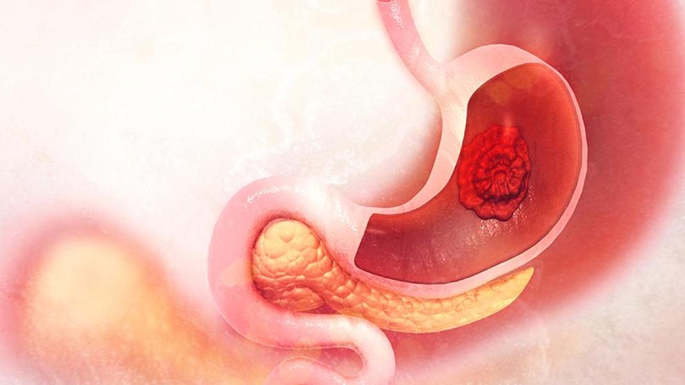 Incidencia del cáncer gástrico a nivel mundial