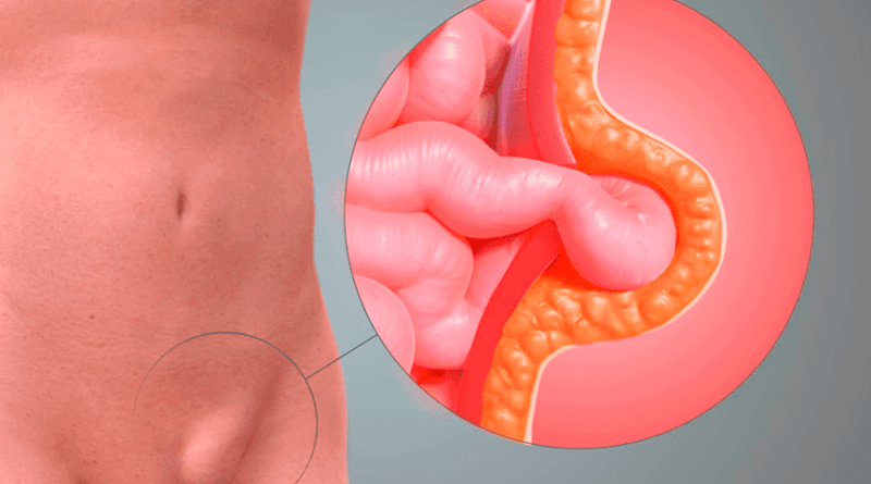 ¿Cuáles son los factores predisponentes de las hernias inguinales?