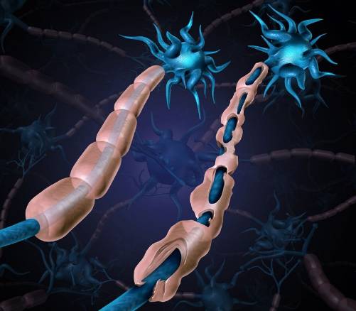 ¿Cuáles son los factores de riesgo para esclerosis múltiple?