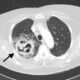 ¿Cuáles son las causas de absceso pulmonar?