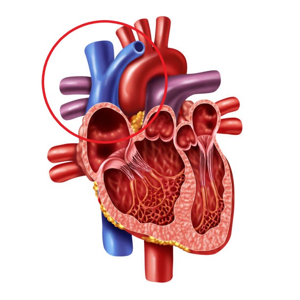 Vena cava superior