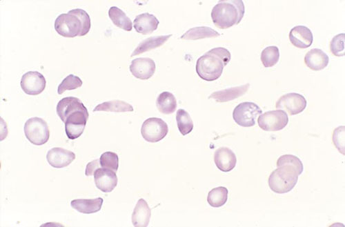 ¿Cómo se clasifican las hemoglobinopatías?