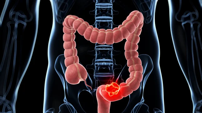 ¿Cuáles son los factores de riesgo para cáncer colorrectal