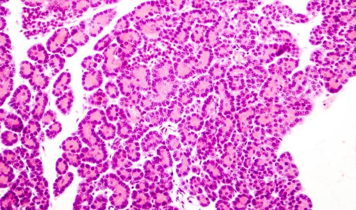 ¿Qué causa la diabetes mellitus tipo 1