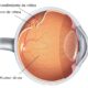 ¿Qué es el desprendimiento de retina regmatógeno?