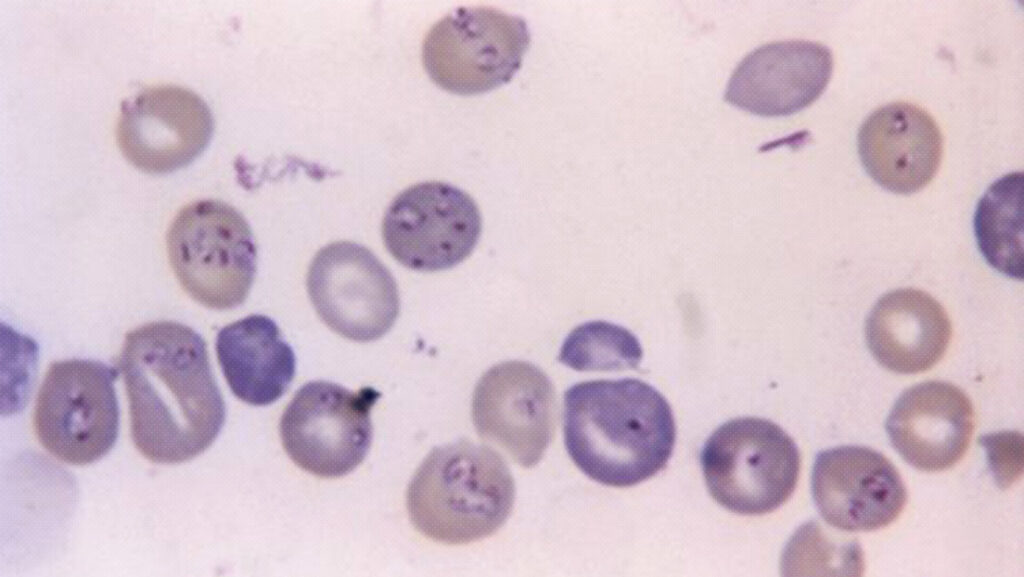 ¿Qué es la babesiosis?