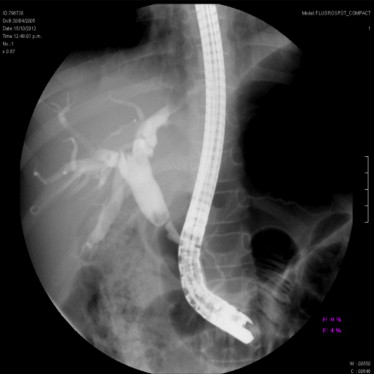 ¿Qué es la estenosis biliar?
