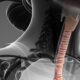 ¿Cuáles son los tipos de neoplasias traqueales?