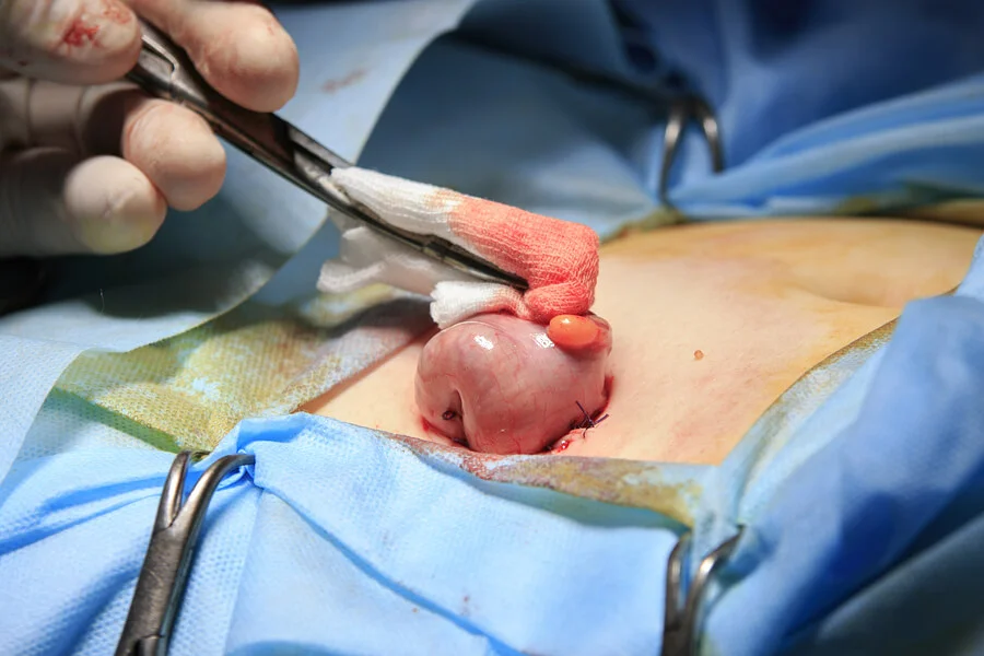 Indicaciones para la formación de una colostomía